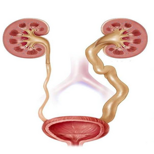 Аномалию развития мочеточников и мочевого пузыря