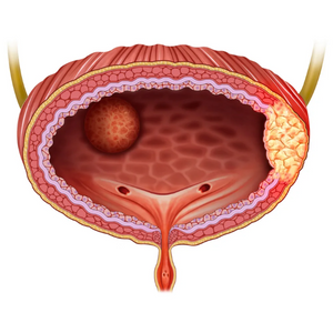 Подозрение на рак мочевого пузыря