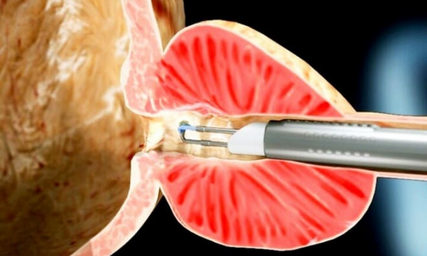 Операция ТУР при аденоме простаты