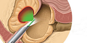 Плазменная операция аденомы простаты