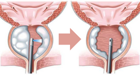 Лазерная операция аденомы простаты