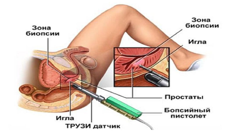 Биопсия простаты