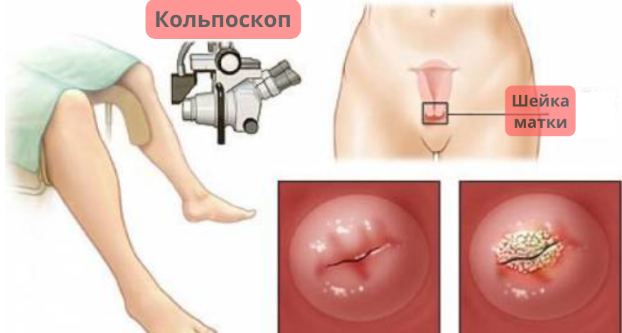 Диагностика рака шейки матки