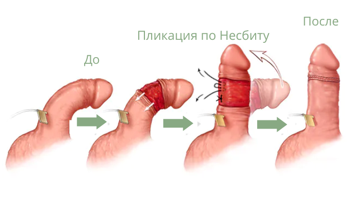 Пликация по Несбиту